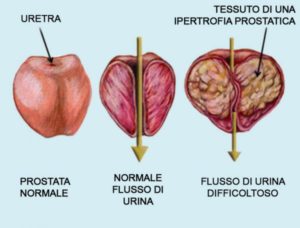 prostata ingrossata sintomi sessuali)